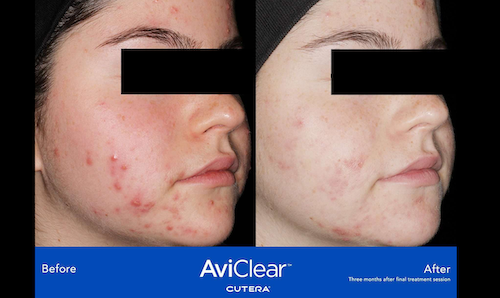 aviclear active acne removal results before after mississauga oakville